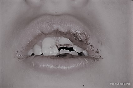 TRAUMATISMES fracture, déplacement ou expulsion d'une dent permanente , l'enfant doit être vu le jour même